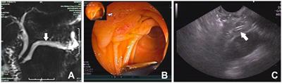 Case report: Endoscopic retrieval of a proximally migrated pancreatic stent using the basket-through- the-sphincterotome technique